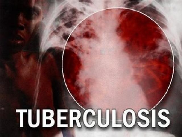 Penderita   Cukup Tinggi, Alat Pemeriksa TBC di Puskesmas Kurang dan Banyak Rusak