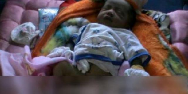 Heboh, Bayi Berkepala Dua Lahir di Bengkulu